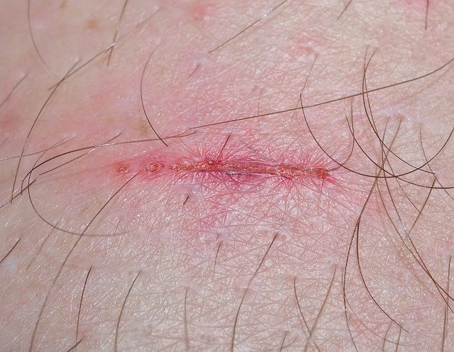 cell injury
